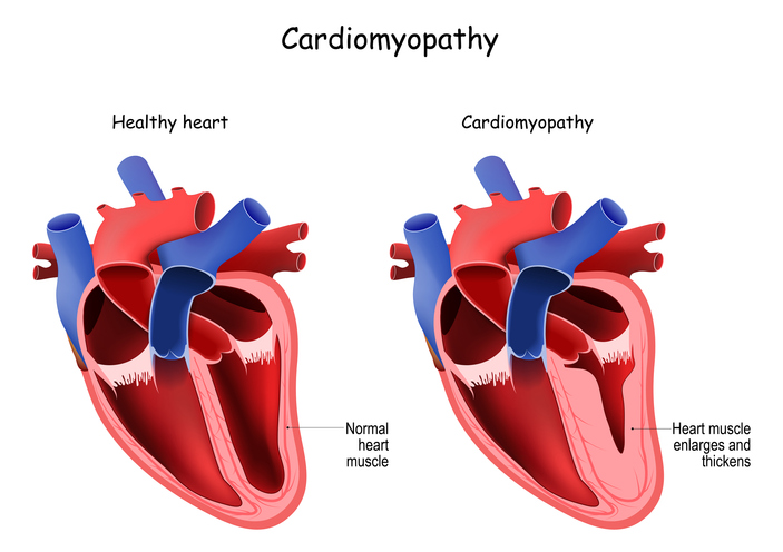 Sybil Wilkes Exclusive: King McClure, Jared Butler And Heart Experts Talk Hypertrophic Cardiomyopathy (HCM)